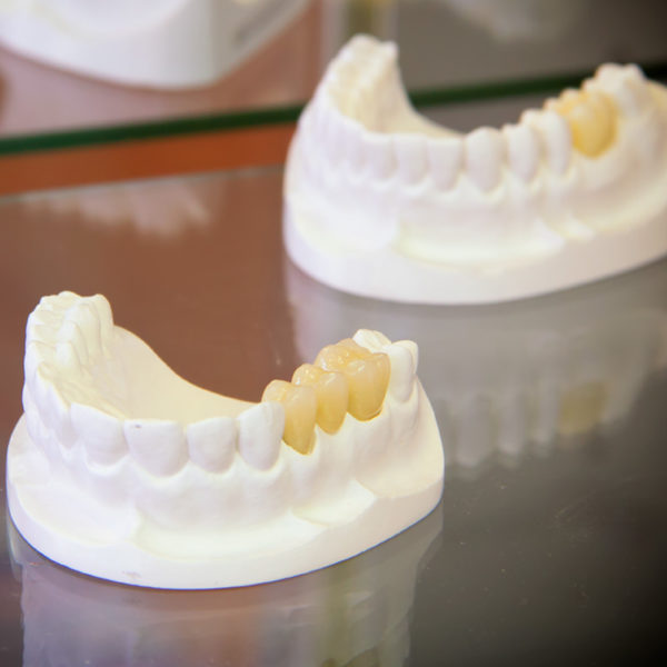 dental implant mold | Reliable Dental Lab | Dallas, TX