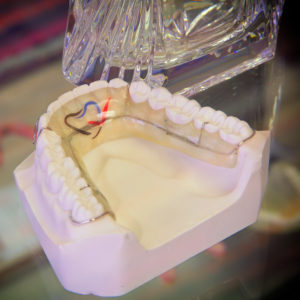 dental nightguard example | Reliable Dental Lab | Dallas, TX