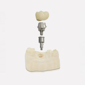 Abutment Dental Implant | Reliable Dental Lab | Dallas, TX