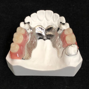 Cast Metal Partial & Flexible Partial | Reliable Dental Lab | Dallas, TX