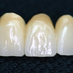 Dental Crowns & Bridges | Reliable Dental Lab | Dallas, TX