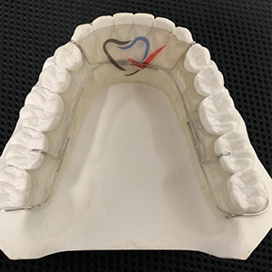 Ortho Appliance Example | Reliable Dental Lab | Dallas, TX