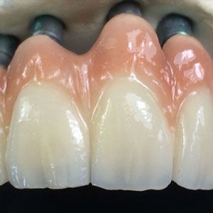 Implant Restorations | Reliable Dental Lab | Dallas, TX